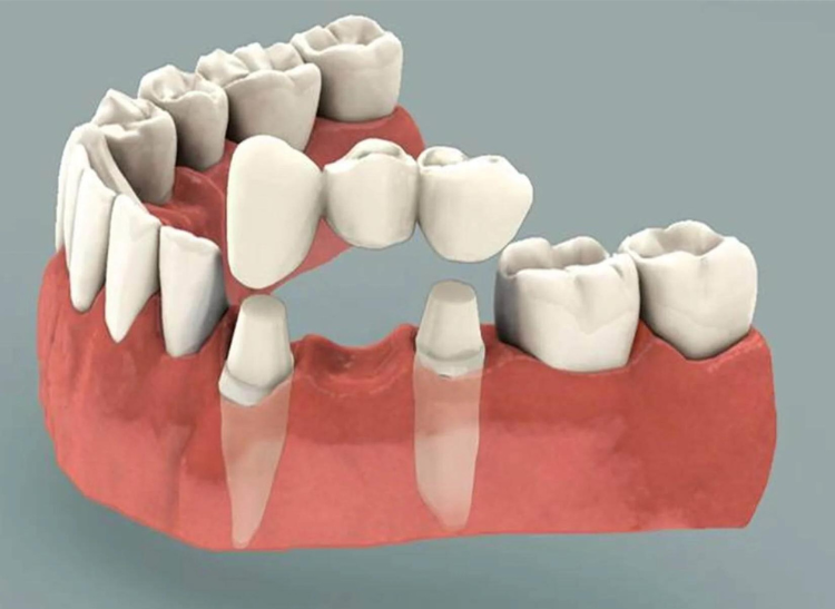 dental bridges website22