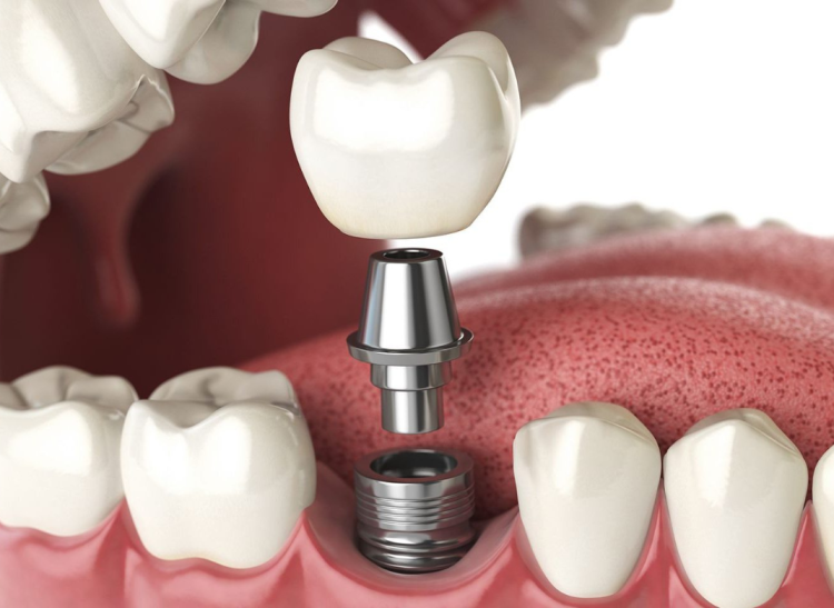 dental implant website